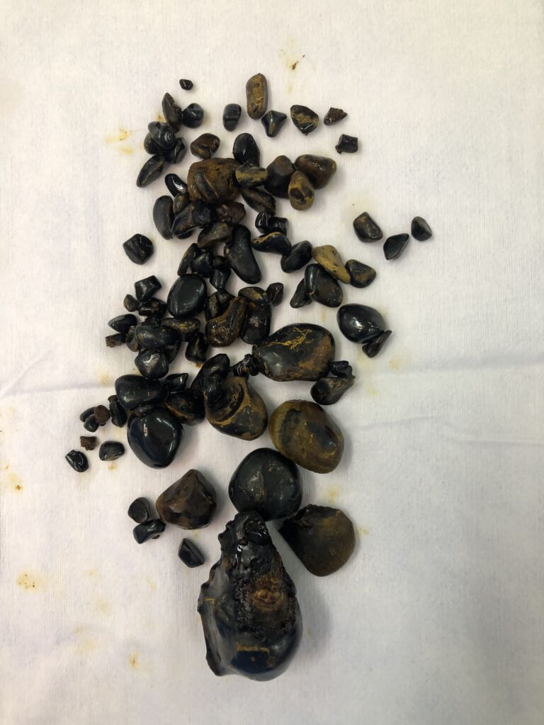 Gắp hơn 100 viên sỏi làm tắc ống mật chủ 1 02b503a95d