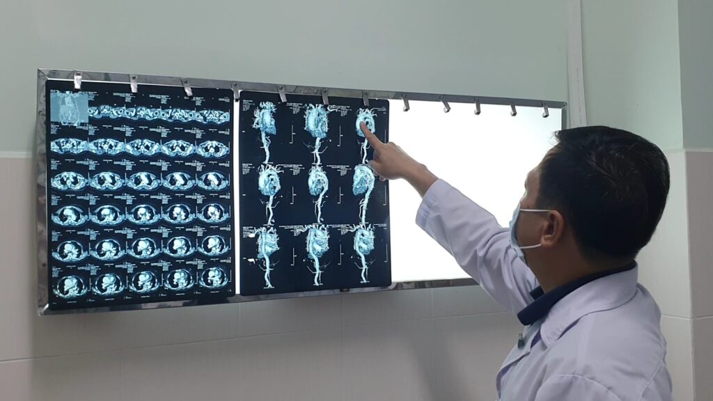 Cứu sống cụ bà vỡ túi phình động mạch chủ ngực 1 1c41bf4635