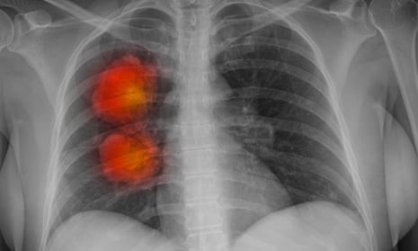 Công cụ AI mới có thể xác định chính xác bệnh ung thư 1 734d330f3f