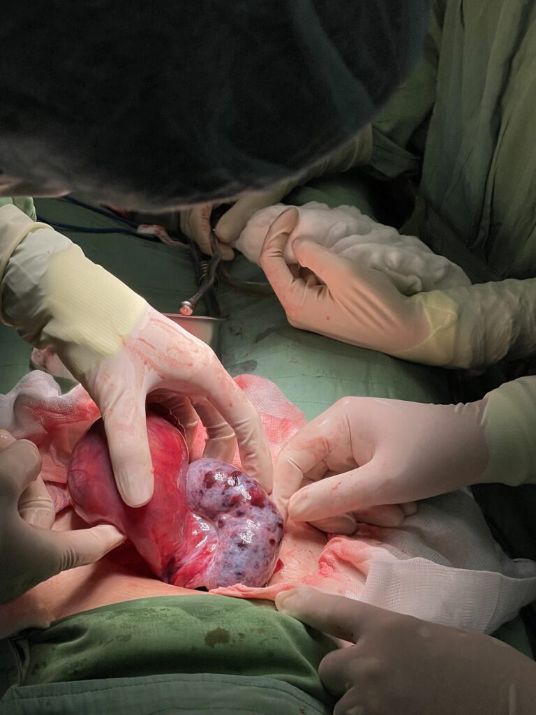 Thực hiện ca mổ khó, giữ buồng trứng cho bé gái 15 tuổi 1 bc8bf7f194