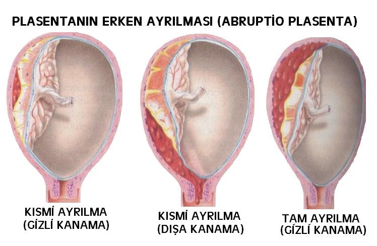 Kịp thời cứu mẹ và con sản phụ bị nhau bong non 1 b905dbf091