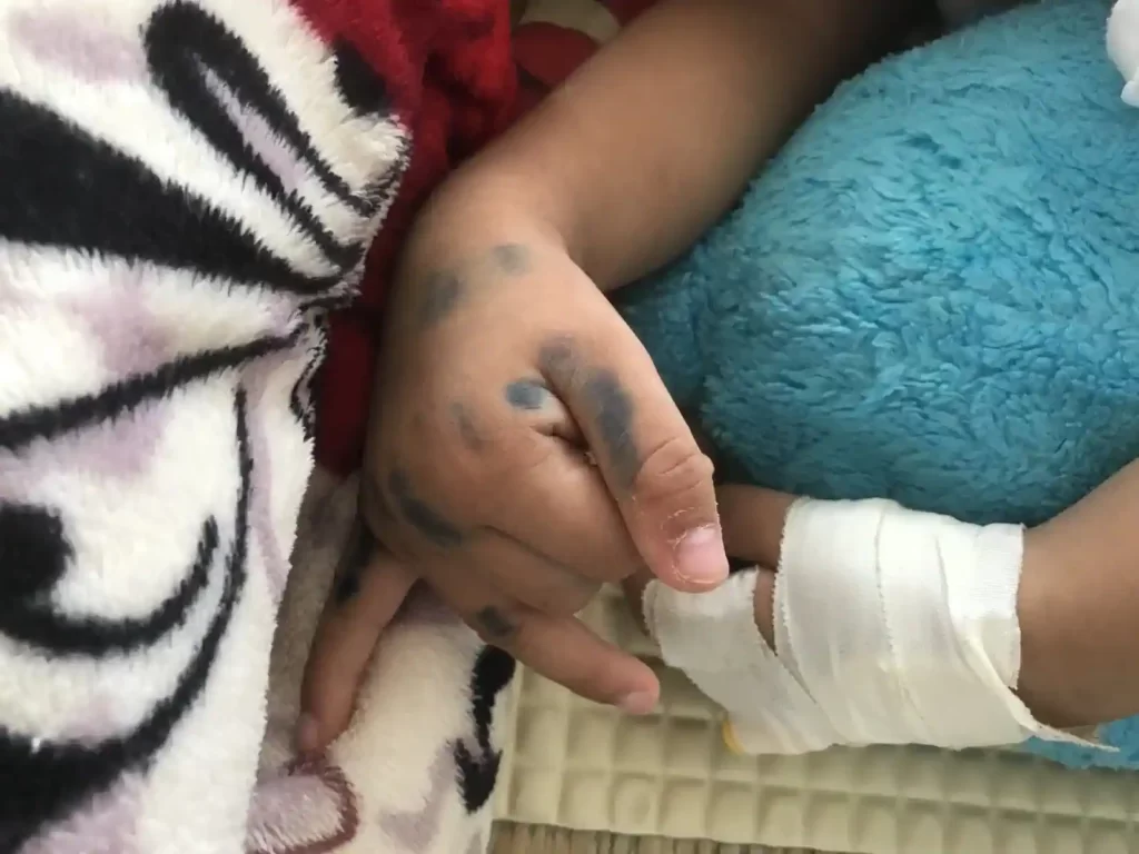 Cứu sống bệnh nhi mắc tay chân miệng nguy kịch 1 7206417401