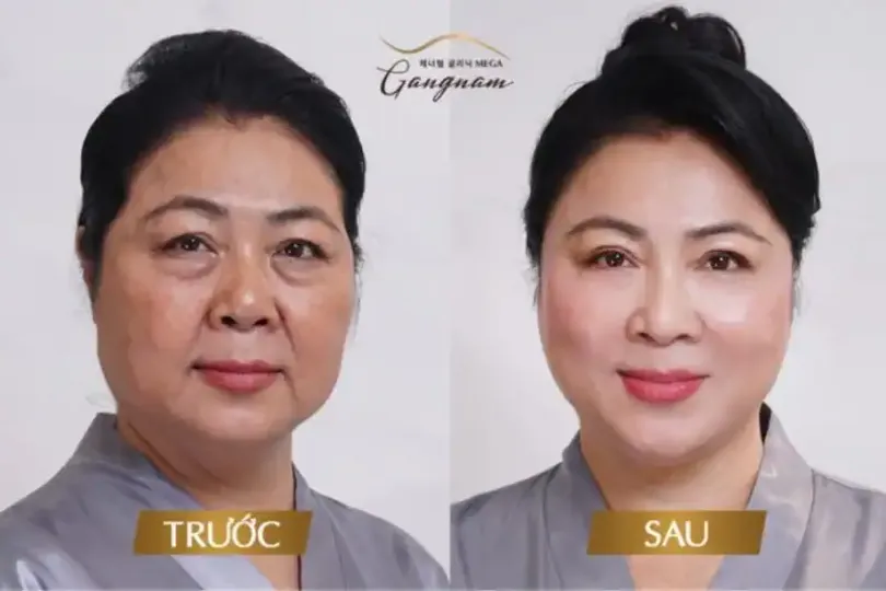 Những lưu ý khi thực hiện căng da mặt? Điểm tên công nghệ mới nhất? 2 cfdaf15fd9