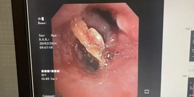 Nội soi gắp mảnh xương dài nằm lâu ngày trong phế quản cụ bà 71 tuổi 2 1709290228