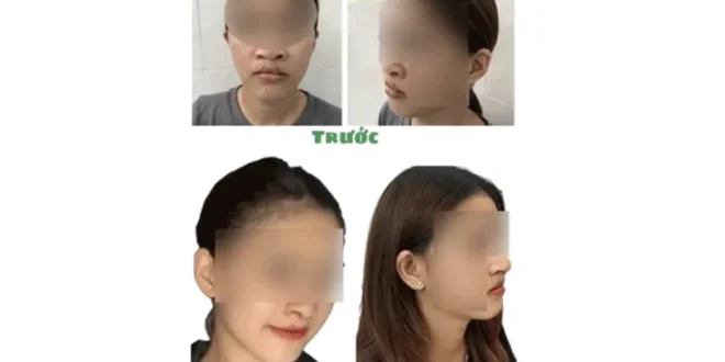 Phẫu thuật chỉnh hình mũi hở hàm ếch cho nữ bệnh nhân 17 tuổi 2 1723779906