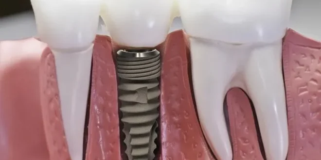 Công nghệ giúp trồng răng Implant không đau tại Nha khoa Quốc tế Phú Hòa 2 1729507031